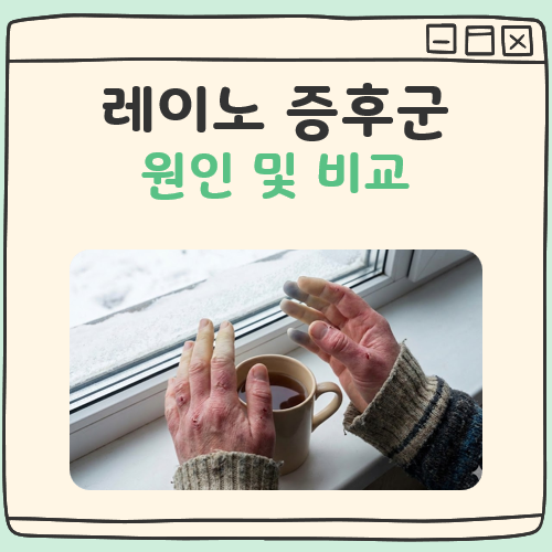 레이노 증후군 단순 냉증 차이